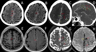 Malignant Isolated Cortical Vein Thrombosis as the Initial Manifestation of Primary Antiphospholipid Syndrome: Lessons on Diagnosis and Management From a Case Report